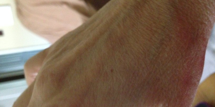 Dry Flaky Skin on My Hand