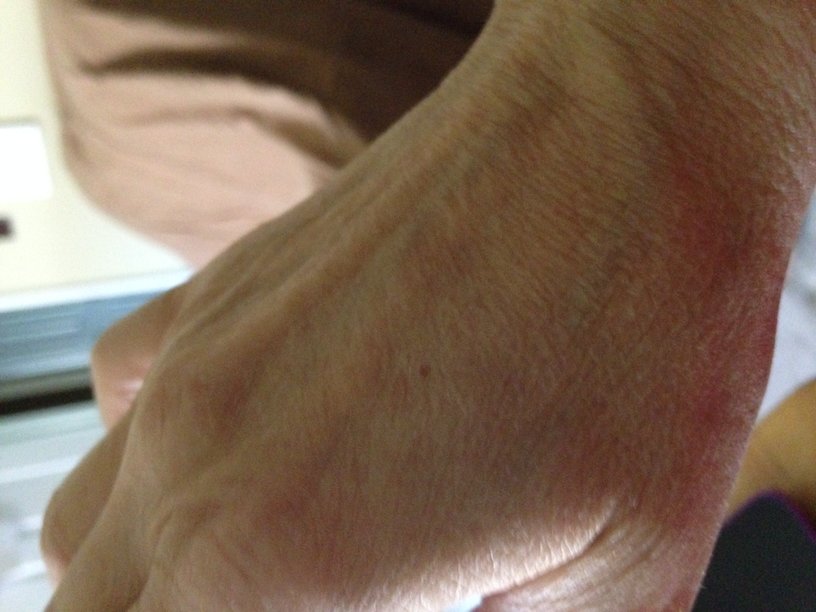 Dry Flaky Skin on My Hand